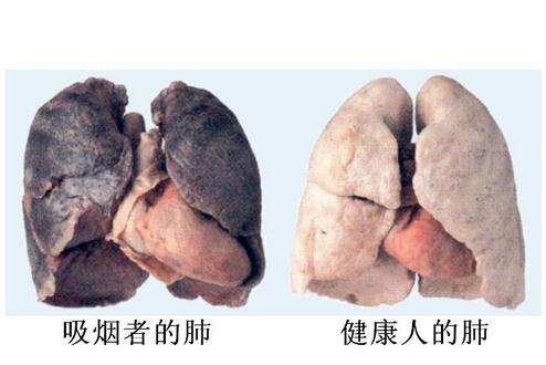 吸烟者的肺图片
